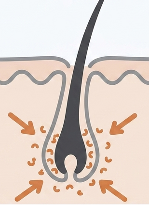 DHT attacks the follicle